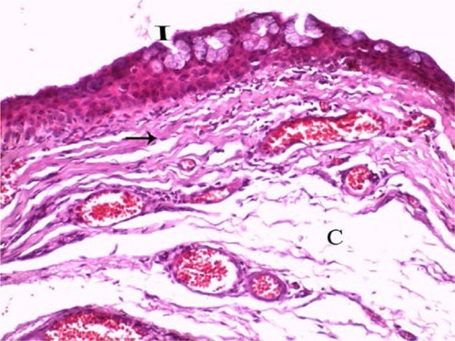 Figure 3 A photomicrograph of untreated pterygium section showing alternative thin and thick areas that appear in the surface epithelium.