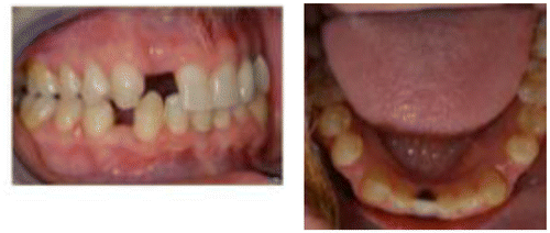 Figure 6 The patient pictured above had his snoring completely resolve after we advanced his lower anterior teeth and opened spaces for extra bicuspid implants. No recession has occurred more than 10 years after the treatment was completed.
