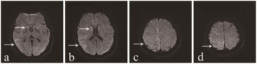 Figure 2. Results of DWI scans.a and b show an increase in signal intensity changes at the surface of the temporal lobe and bilateral basal ganglia regions (especially the caudate nucleus). c and d show ribbon-like signals in the right parietal lobe.