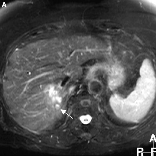 Figure 1A.  T2-weighted MR image shows one hyperintense metastasis in segment 7 with a small satellite lesion (arrow).