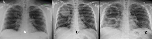 Figure 1 (A) Radiograph of the right upper lobe nodal consolidation with internal cyst formation. (B) Radiograph of right upper lobe cavitary mass like opacity with left lower lobe nodule. (C) Chest radiograph, multiple bilateral cavitary lesions with air-fluid levels, and the largest in the right upper lobe.
