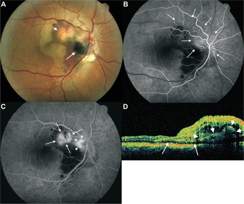 Figure 1 Fundus color image, fluorescein angiography and optical coherence tomography findings in patient’s right eye at initial examination.