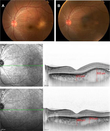 Figure 4 Subretinal fluid was absorbed and mass lesion was shrunk after the administration of the sub-tenon steroid injection. Fundus photograph at 2 weeks (A) and 28 months (B) after the injection. Enhanced depth imaging-OCT at 2 weeks (C) and 10 months (D) after injection. The green arrow shows the location of the horizontal section of OCT.