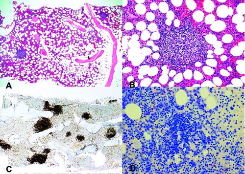 Figure 1 Cold agglutinin-associated lymphoproliferative bone marrow disorder. Bone marrow trephine biopsy showing intraparenchymatous nodular lymphoid lesions (panels A and B, H&E staining, 40× and 200×, respectively). Immunoperoxidase staining for CD20 highlights intraparenchymatous nodular B-cell infiltration (panel C, 200×). Mast cells are not discerned around the nodular lymphoid lesions (panel D, Giemsa staining, 200×). Notes: Reproduced with permission from Randen U, Trøen G, Tierens A, et al. Primary cold agglutinin-associated lymphoproliferative disease: a B-cell lymphoma of the bone marrow distinct from lymphoplasmacytic lymphoma. Haematologica. 2014;99(3):497–504.Citation5 Copyright © 2014 Ferrata Storti Foundation.