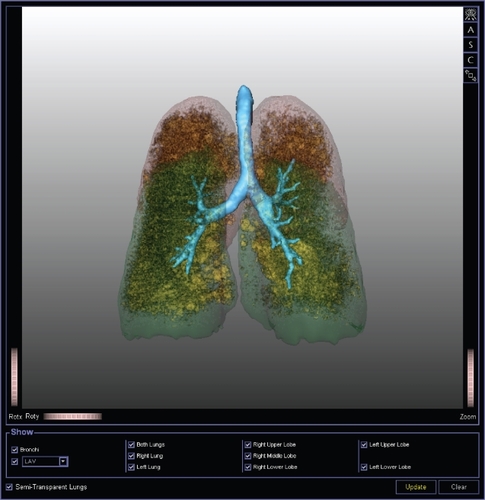 Figure 4 3D rendering of thin-section CT (postero-anterior view) scan with tracheobronchial tree (azure-blue) and both lower lobes (green) and upper lobes (red). Inside lobes all pixels of −950 HU or less are highlighted (yellow), identifying areas of emphysema. Image generated using MeVisPULMO software (www.mevis.de). (Courtesy of Jan-Martin Kuhnigk, Bremen, Germany).