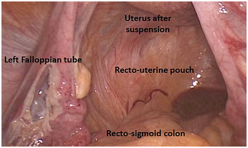 Figure 12. The recto-uterine pouch, a peritoneal space formed by peritoneal deflection between rectum and uterus, and the septum formed by the union of Rathke’s folds, forming the rectum of the fetus, are named after James Douglas. James Douglas (1675–1742) was a Scottish physician and anatomist. Douglas worked as an obstetrician and was the Physician Extraordinary to Queen Caroline wife of King George II of Great Britain.