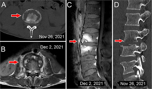 Figure 3 CT and MR images of lesion site.