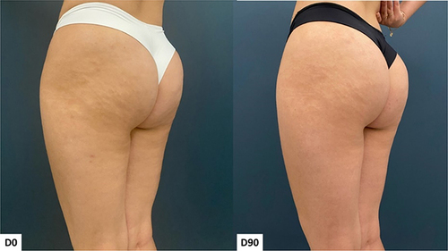 Figure 6 Case 3, Buttocks Beautification 3D. Standardized oblique images pre and 90 days post injection.