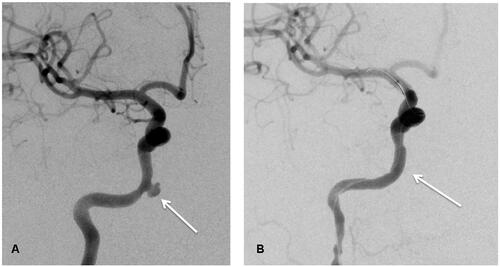 Figure 3. (A) Image before Willis covered stent implantation (white arrow shows the bleeding site); (B) Image after Willis covered stent implantation.