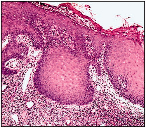 Figure 7. Severe epithelial dysplasia before the treatment showing acanthotic epithelium with drop shape rete pege’s process (H&E ×200).