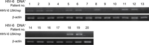 Figure 1 The expression of U94/rep in glioma tissues with positive HHV-6 infection.Note: The mRNA expression of U94/rep was evaluated in the 20 glioma tissues with positive HHV-6 infection.Abbreviation: HHV-6, human herpesvirus 6.