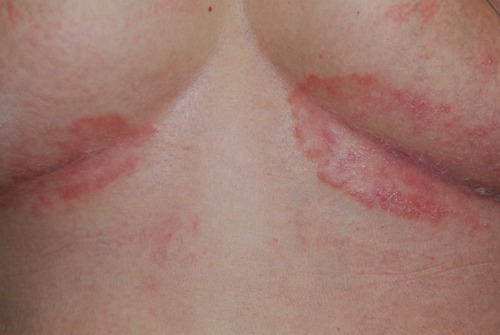 Figure 1 Inverse psoriasis of the inframammary folds in a 38-year-old woman: well demarcated, erythematous patches with fine scaling.