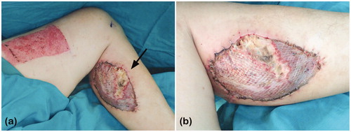 Figure 2. (a) Partial loss of the skin graft and (b) necrotic underlying muscle of the medial gastrocnemius at the donor site, indicated by the black arrow.