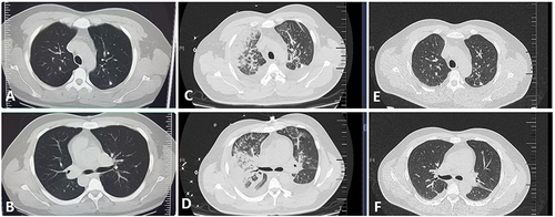Figure 5 Chest computed tomography scans on day 1 (A and B), day 3 (C and D), and day 11 (E and F). (A and B) clear lungs. (C and D) bronchitis, bilateral lung inflammation, interlobular septal thickening, bilateral pleural effusions. (E and F), a marked improvement in inflammation and reduced pleural effusion.