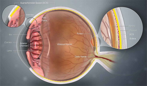Figure 1. Cross-sectional anatomy illustration of the human eye. The suprachoroidal space (SCS) is denoted in yellow and is occluded anteriorly by the scleral spur, as seen in the magnified region of the illustration. Image updated from https://www.scientificanimations.com, CC BY-SA 4.0, via Wikimedia Commons