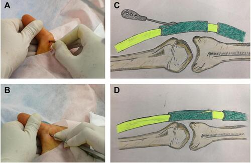 Figure 2 The process of modified acupotomy release. (A) After skin sterilization and local anesthesia, a 3-mm longitudinal stab incision was then made. (B) The modified acupotomy was inserted into the same track to reach the proximal edge of the A1 pulley, then slipped into the space between the pulley and the flexor tendon. (C) The modified acupotomy was gently pushed distally to release the A1 pulley with the sharp J-shaped edge. (D) The A1 pulley was completely released by the modified acupotomy.