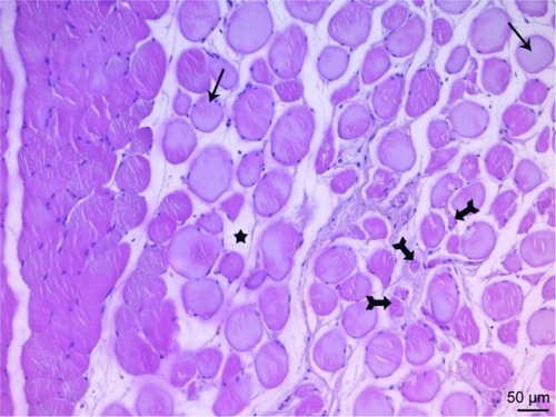 Figure 7 In the micrograph of the ischemia reperfusion group, the cross-sectional faces of the muscle fibers are observed to have a rounded (arrow) shape. Increase in endomysium distance between the fibers (star) and atrophy in the muscle fibers (tailed arrow) are also observed. H&E ×200.