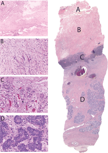 Figure 6. Histologic section of treated mammary gland. (A) Completely adjacent glandular structure immediately adjacent to the hot balloon. Underlying necrotic glands with normal appearing nuclei. (B) Glandular tissue with prominent new vessel formation, polymorphonuclear cells, and karyorrhectic debris. (C) Prominent new vessel formation in a background of myxoid stroma with mostly mononuclear cell infiltrate. No residual ductal glands are seen. (D) Morphologically normal mammary gland.