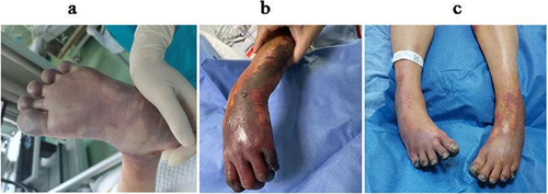 Figure 5 Limb ischemia following SDSE infection.