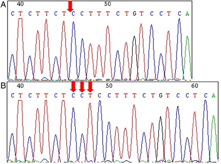 Figure 1. The deletion of CCT (rs2307859) at position 12384–12386 in the A20 gene. (A) T-ALL case with a CCT deletion. The arrow indicates the deletion position. (B) T-ALL case with a wild type sequence. The arrow indicates the wild-type sequence with a CCT at position 12384–12386 in the A20 gene.