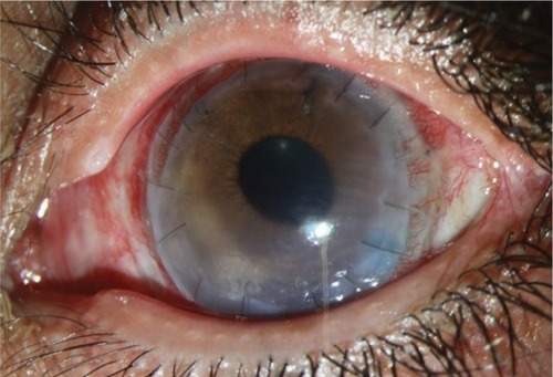 Figure 5 Patient with considerably clear optical zone after penetrating keratoplasty.