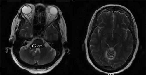 Figure 1. (left) Initial magnetic resonance imaging (MRI) right cerebellar peduncle lesion. (right) Initial MRI left frontal lesion