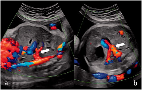 Figure 1. Vascular communication between aorta and portal system depicted by a white arrow in sagittal view (a) and transverse view (b).