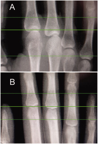 Figure 1. Scout view (radiographs) generated by HR-pQCT for region of interest acquisition (region between the dot lines). The operator places the reference line (continuous line) at the midpoint of the concave articular surface at the base of the 2nd metacarpal head, extending 9.02 mm in distal direction and 18.04 mm in the proximal direction (A). For proximal interphalangeal joints (PIP) evaluation, the reference line is placed at the 2nd proximal phalanx, extending 9.02 mm in both directions (B).