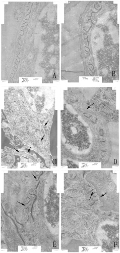 Figure 3. Ultrastructure changes of renal tissue as monitored by transmission electron microscopy. (A) Control. (B) Solvent control. (C) TCE+, with basement membrane thickening, foot process fusions, swelling and vacuolar degeneration of mitochondria. (D) TCE−, with basement membrane thickening. (E) PDTC+, basement membrane thickening, foot process fusions. (F) PDTC−, with basement membrane thickening, foot process fusions. Black arrows indicate podo-cytes and mitochondrial vacuolar degeneration, and glomerular basement membrane thickening. Changes noted in (C) were alleviated in (E). Magnification = 20, 000X.