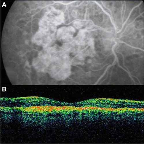 Figure 2 Geographic atrophy. (A) Fluorescein angiography demonstrated hyperfluorescence due to a window defect and central sparing. (B) Stratus optical coherence tomography image showing a significant loss of the outer nuclear layer, photoreceptors, and the retinal pigment epithelium, leading to significant hyperreflectivity and backscatter within the choroid.