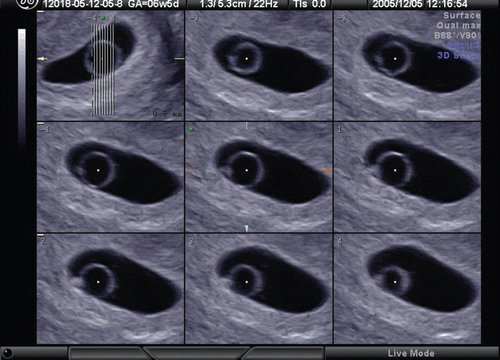 Figure 18.  Tomographic imaging of large yolk sac at 6 weeks of gestation. Large yolk sac with normal fetal heart beat was observed. Fetal demise was confirmed at 8 weeks. Villous chromosome exam resulted in 47, XY, +22.
