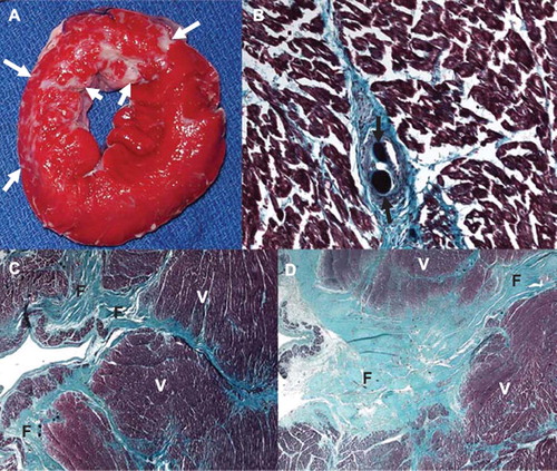 Figure 7. Histochemical and histopathological visualization of the heterogeneous small infarcts caused by microemboli (microinfarcts) and the deposition of microemboli in the coronary vasculature. A. TTC staining of the gross sample showing unstained pale areas (white arrows) corresponding to healed heterogeneous infarcts in the microembolized area. The short axis slice is displayed with the anterior wall up and the septum to the left. B. High power microscopic image from a Masson trichrome staining showing two microemboli (black arrows) trapped in the microvasculature and an organized thrombus surrounding it. C and D. Low power microscopic images showing different sizes of tongues of fibrotic tissue (F) from the epicardium (left) towards the endocardium (right) interspersed with viable tissue (V) stained by Masson trichrome. The difference in fibrotic tissue sizes seen in C and D is most likely related to the differences in diameters of obstructed microvessels.