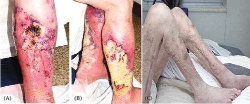 Figure 1. (A) Early stage of calcific uremic arteriolopathy (CUA) skin lesions on the right medial calf. (B) Progressive CUA skin lesions appear as deep necrotic ulcers on the bilateral lower limbs. (C) Resolution of CUA skin lesions after STS treatment.