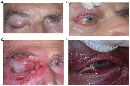 Figure 4 (A and B) Photographic documentation of ptosis and conjunctival chemosis involving the right eye. (C and D) Massive extension at the right ocular adnexa with ptosis, proptosis, and periorbital tissue infiltration.