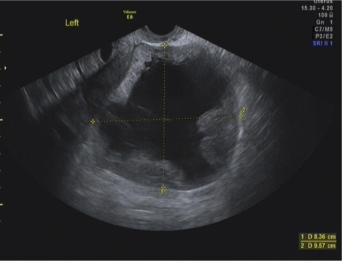 Figure 8 Transvaginal ultrasound in a 64-year-old woman with pelvic mass.