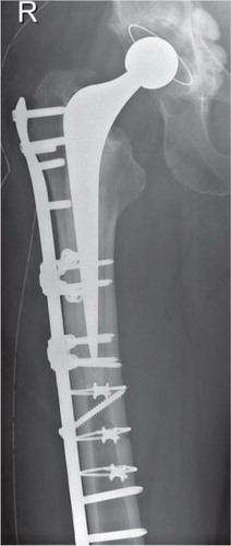 Figure 1. Reoperation after a new fall and loss of fixation (the stem remained stable). Open reduction and internal fixation using a locking plate, additional cable, and locking attachment devices was performed to obtain absolute stability. The locking plate spanned both the femoral stem and the distal part of the femoral diaphysis.