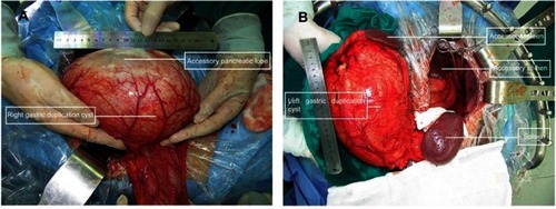 Figure 3 (A) The right duplication cyst and the accessory pancreatic lobe during operation; (B) the left duplication cyst and the accessory spleens.