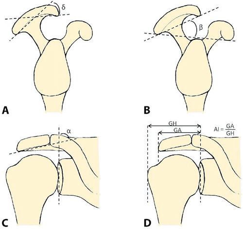 Figure 1. Overview of parameters of acromial morphology.