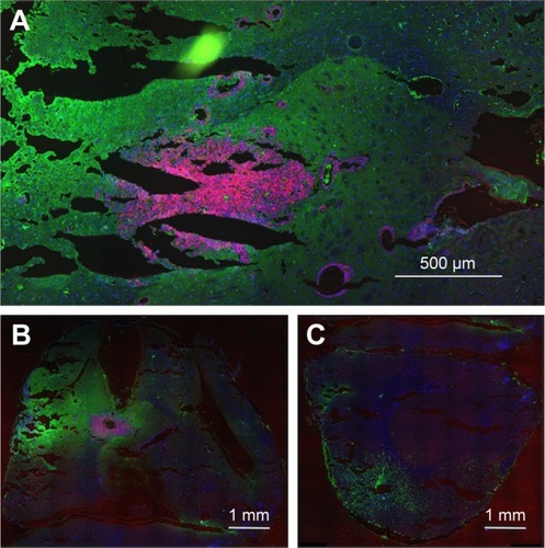 Figure 1 Tumor cells and edema in the brains of rats with advanced F98 gliomas.Notes: (A and B) Left hemisphere (two separate rats) and (C) right hemisphere. (A–C) mCherry red (tumor, red), anti-albumin (edema, green), and DAPI (nuclei, blue).