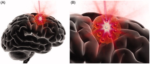 Figure 3. Illustration of brain tumor nanoparticle-mediated photothermal therapy (PTT). (A) Schematic representation of local NIR light application to a brain tumor after photothermal agents (PTAs) administration (black spheres). (B) Schematic illustration demonstrating NIR light excitation of PTAs within the brain tumor. PTAs absorb NIR light and emit thermal energy acting as local heat sources.