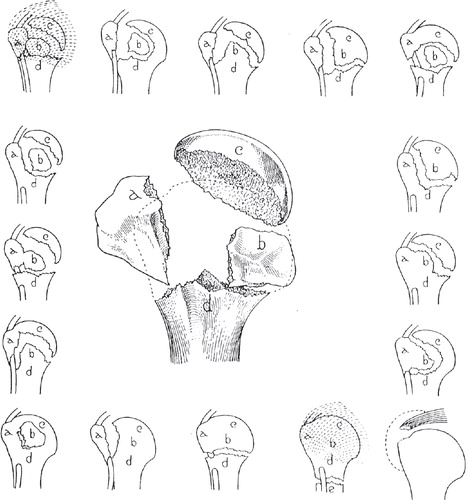 Figure 18. The four anatomical segments of the proximal humerus. Reprinted from Codman (Citation1934) 110 with permission from Krieger Publishing Company.