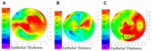 Figure 10 Examples of localized thinner epithelium over protruding corneas. (A and B) KCN patients, (C) a PMD patient.