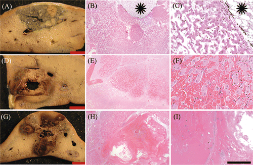 Figure 2 Histology: Gross and corresponding histologic sections after acid (A, B, C), simultaneous (D, E, F) or sequential (G, H, I) injection. Cells in ablated regions exhibit coagulative necrosis and are shrunken with pale cytoplasm and indistinct nuclei compared to unablated tissue (inset, C). Haemorrhage is obvious in simultaneous and sequential sections (E, F). Imaging marker (spaghetti) is visible in histological sections (B, C, stars). A, D, G: Bar equals 1 cm. B, E, H: H&E, 40× magnification, bar equals 500 µm. C, F, I: H&E, 400× magnification, bar equals 50 µm.