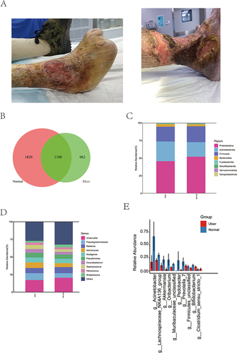 Figure 1 Species analysis. (A) The representative images of the ulcers of patients. (B) Venn diagram of the ASV feature of the ulcer and normal skin groups; (C) column stacking diagram of the distribution of major species at the phylum level; (D) column stacking diagram of the distribution of major species at the genus level; (E) Species with significant differences between groups at the genus level, showing the top 10 species in terms of degree of difference.
