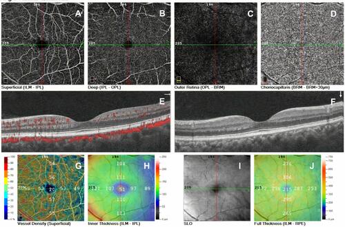 Figure 1 Optical coherence tomography angiography images of the left eye of an included patient showing superficial and deep plexuses (A and B), outer retina (C), choriocapillaris (D), cross-sectional B-scans (E and F) with angio overlay (E), vessel density (superficial) (G), inner thickness (H), scanning laser ophthalmoscopy (I) and full thickness images (J).
