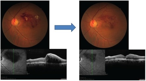 Figure 2 Case two: fundus and optical coherence tomographic images of a 62-year-old woman with BRVO before and after treatment of her systemic hypertension with an angiotensin II blocker.