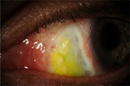 Figure 2 Photograph of nasal scleral thinning and overlying calcific plaques of the left eye.