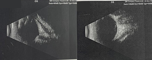 Figure 2 B-scan image to confirm the diagnosis of aphakia in the presence of sclerocornea.