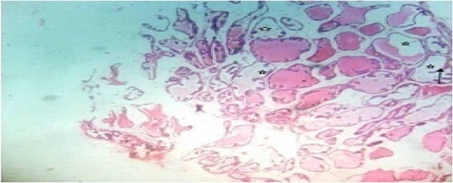 Figure 6. High dose: Photomicrograph of prostate tissue showed glandular hyperplasia predominated and characterized by exaggerated intra-acinar papillary infoldings (convolutions) (black arrow) with fibrovascular cores. Infiltrates mainly lymphocytic cells were observed in the acinar without any admixed tumor cells. Secretions (star) in the acini were observed. H&E. mag. 400×.