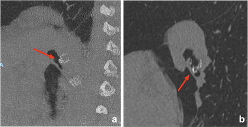 Figure 3. Images of thorax CT scan showing valve migration. In this case, the left lower lobe was treated with endobronchial valves and 6 weeks after treatment a complete atelectasis of the target lobe was achieved with a significant clinical benefit. After six months, there was loss of clinical benefit and no more lung volume reduction. (a): EBV well positioned in LB6. (b): Complete re-expansion of the treated lobe, the valve in LB6 is dislocated and now in a different position compared to the follow-up scan at six weeks